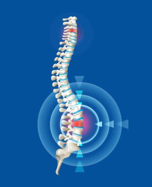 Endoscopic Spine Surgery