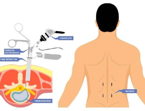 Minimally Invasive Spine Surgery Types and Benefits