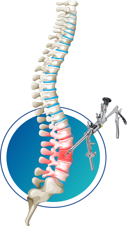 spine surgery spine surgery